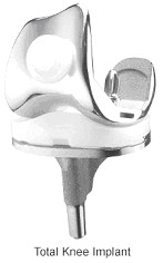 Parts and Materials for Knee Replacements